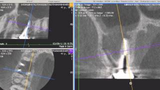 Apport du laser ErbiumYag en endodontie chirurgicale Dr David Bensoussan  Vidéo 1 [upl. by Vivien]