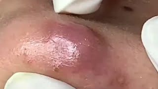 Blackheads Removal  Acne Treatment and Very Satisfying Satisfying Pimple pop blackheads [upl. by Baldwin]