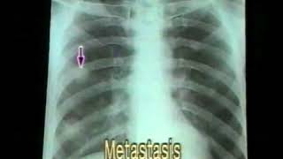 31 Bronchogenic Carcinoma  Chest XRays  Dr Vaidya [upl. by Cida]