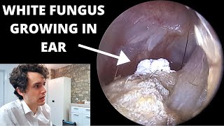 White Fur Growing in Ear Removed With Suction Otomycosis Fungal Infection [upl. by Ettenig]