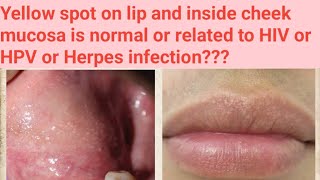 yellow spot on lipwhat to doFordyces granules in cheek related to HIV or HPV or Herpes infection [upl. by Safire]