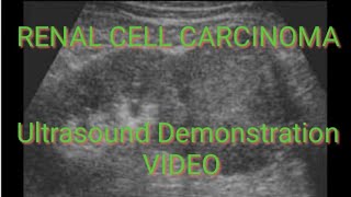 RENAL CELL CARCINOMA on Ultrasound Video Demonstration [upl. by Gretel478]