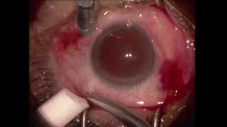 Vitrectomie pelage pour membrane epimaculaire  Vitrectomy for epiretinal membrane [upl. by Derna901]