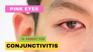 14 REMEDIES FOR CONJUCTIVITIS OR PINK EYES [upl. by Yila]