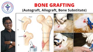 BONE GRAFTING  Lecture 05  Orthopedics [upl. by Orpha915]