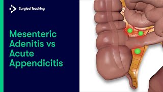 Mesenteric Adenitis vs Appendicitis  How to tell the difference [upl. by Nomahs41]