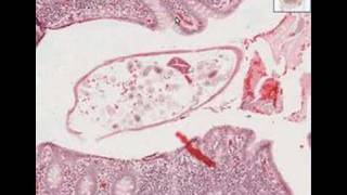 Histopathology AppendixPinworms [upl. by Leann]