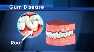 What are Cavities [upl. by Dionysus]