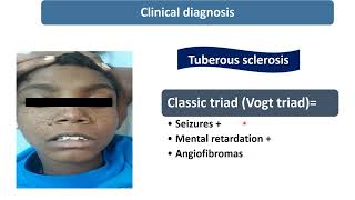 Tuberous Sclerosis  Spot Diagnosis  8  Pediatrics [upl. by Rosse960]