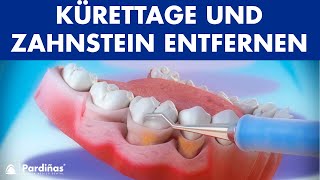 Parodontosebehandlung  Kürettage und Zahnstein entfernen © [upl. by Dias]