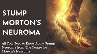 Detailed account of the diagnosis and treatment of Stump Mortons Neuroma [upl. by Haidadej280]