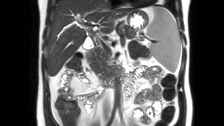 Primary Sclerosing Cholangitis PSC [upl. by Hanima]