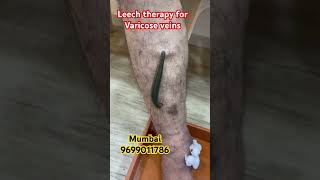 Can leeches help with varicose veins  LEECH THERAPY kzhijamaleechvaricoseshortsreelstrend [upl. by Surad]