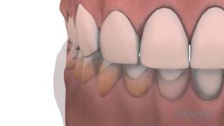 Gingivoplasty and gingivectomy  Lapointe dental centres [upl. by Charyl135]