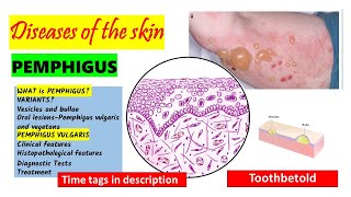 Pemphigus Vulgaris  HISTOPATHOLOGY  Immunofluorescence  Treatment  PART 22 [upl. by Brynn635]