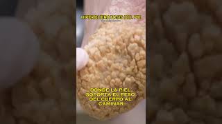 HIPERQUERATOSIS DEL PIE [upl. by Asennav616]