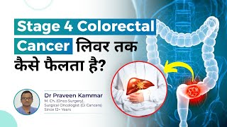 Stage 4 Colon amp rectal Cancer लिवर तक कैसे फैलता है  Stage 4 Cancer Explained  Dr Praveen Kammar [upl. by Kenay]