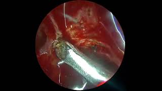 Anterior ethmoidal artery leak by prof dr jaskaran singh [upl. by Sibylla]