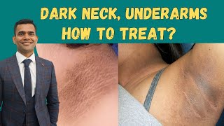 Dark Neck  Simple Solutions To Get Rid Of Black Neck  Black Armpits  Dr Vivek Joshi [upl. by Yssenhguahs]