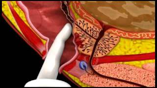 Prostate Cancer  3D Medical Animation  ABP © [upl. by Nalahs]