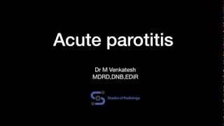 Acute parotitisUSG features [upl. by Llehsram]