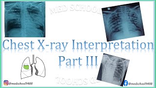 Chest Xray interpretation made easy III [upl. by Anitra558]