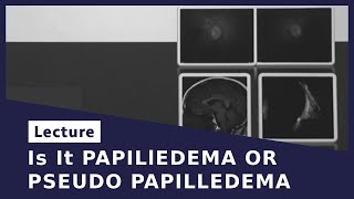 Is It PAPILlEDEMA OR PSEUDO PAPILLEDEMA [upl. by Bastian]