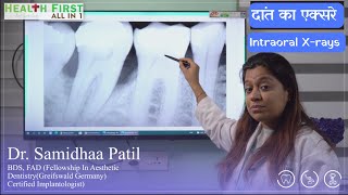 Dental XRay Types  दांतों के एक्सरे Part 2 Intraoral Xrays  Dental Clinic HeathFirst All in 1 [upl. by Akeimat]