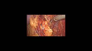 Laparoscopic Nephrectomy by Dr Negi [upl. by Ahsiekam]