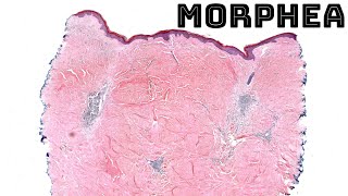 Morphea under the microscope localized scleroderma skin disease histology pathology dermatology [upl. by Vita]