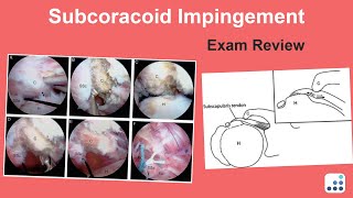 Subcoracoid Impingement Exam Review  Jay Keener MD [upl. by Ferullo]