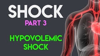 Hypovolemic Shock  Shock Part 3 [upl. by Aidaas]