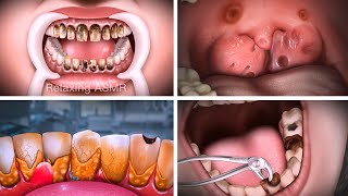 ASMR The best treatment Numbness with wisdom teeth ingrown teeth  Relaxing animation [upl. by Warring]