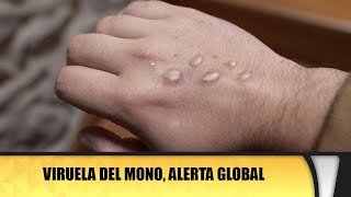 Viruela del mono alerta global [upl. by Milissent]