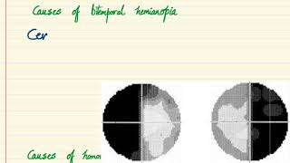 Ocular signs  Bitemporal Hemianopia and Homonymous Hemianopia [upl. by Wolfson6]