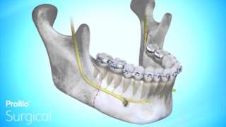 BSSO  Lower Jaw Advancement Surgery [upl. by Nosyrb868]