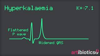 Hyperkalaemia ECG changes animated [upl. by Ard]