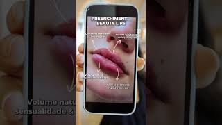 Preenchimento Labial perfeito  técnica beauty lips [upl. by Ramu513]