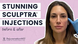 Sculptra Face Injections AntiAging Treatment for Healthier YoungerLooking Skin [upl. by Heathcote]