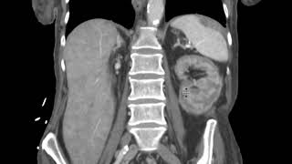 Renal cortical necrosis on CT [upl. by Tenej]