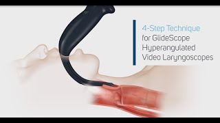 How to Intubate Using a GlideScope® Video Laryngoscope in 4 Steps [upl. by Dituri867]