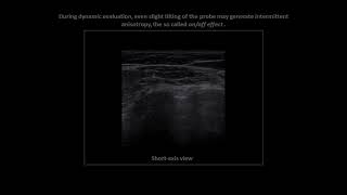 Long head of biceps brachii tendon anisotropy on shoulder ultrasound [upl. by Whitney]