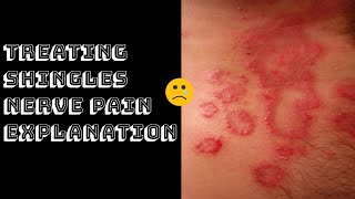 Treating Shingles Nerve Pain Explanation [upl. by Mcintyre]