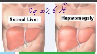 What is Hepatomegaly in URDU Hindima hassan [upl. by Repsaj]