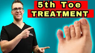 What To Do For A Broken Pinky Toe How To Tape amp Little Toe Treatment [upl. by Vincents]