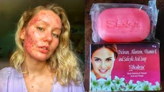 Skin Brite Soap For Pimples And Acne Skin  httpsyoutubecomDilliKitchen72sixMrb09dOECp8LdT [upl. by Conte624]