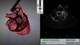 HeartWorks Mechanical Aortic Valve [upl. by Brose]