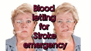 Bleeding to save Stroke and Heart attack emergency [upl. by Jaal615]