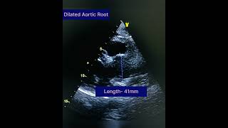 Aortic Aneurysmdilated Aortic Root Dilated Ascending Aorta echocardiography TheEchoManHR [upl. by Ul]