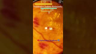 Diabetic retinopathy  Hemorrhages  proliferative diabetic retinopathy PDR  Short Video 185 [upl. by Rdnaskela]